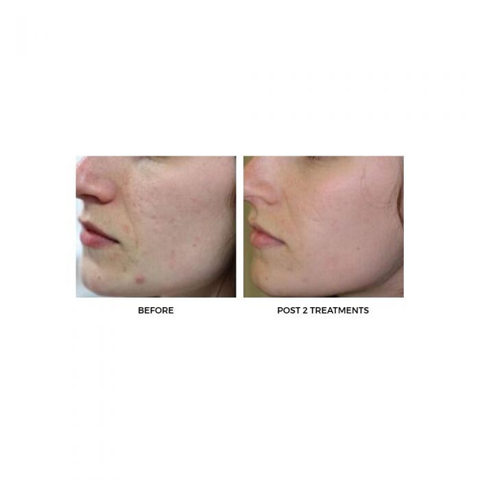 8 in 1 anti aging machine with Hydra , Oxygen , LED, RF